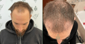 Haartransplantation an Stirn und Scheitel