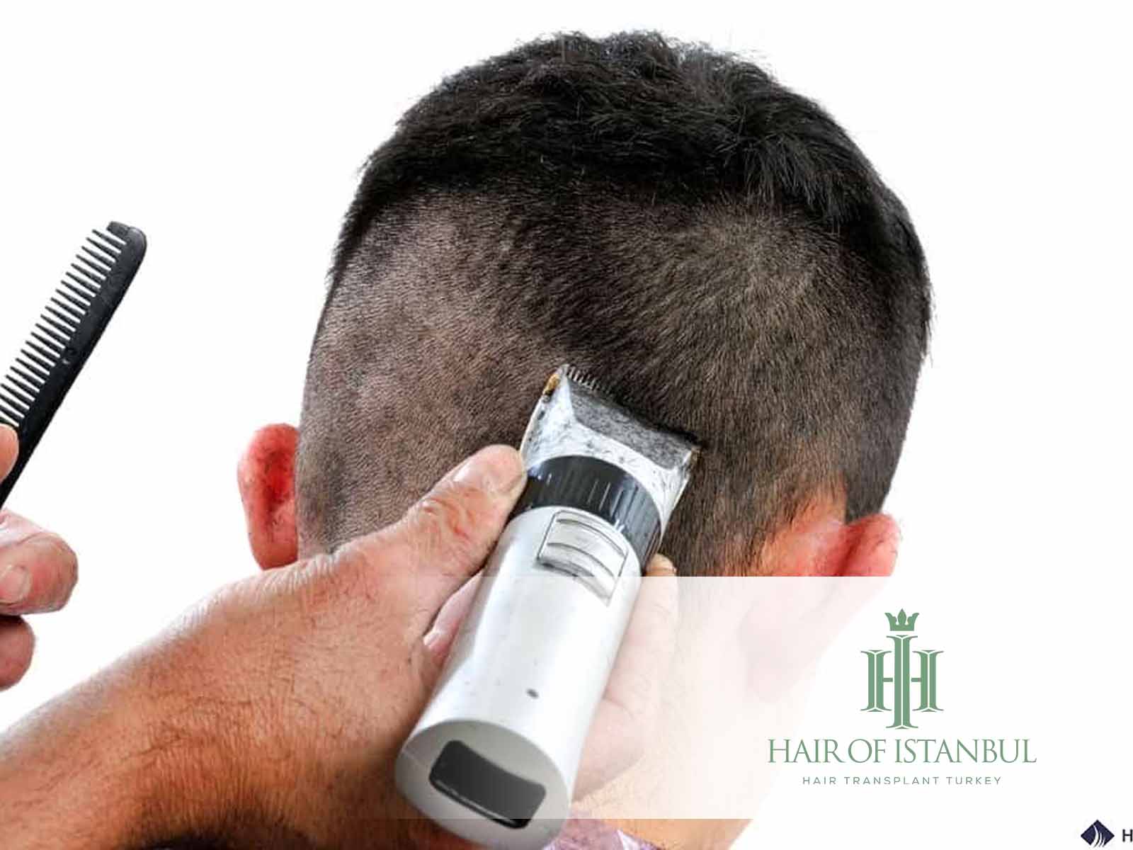 Haartransplantation bei Tonsur: Eine umfassende Anleitung