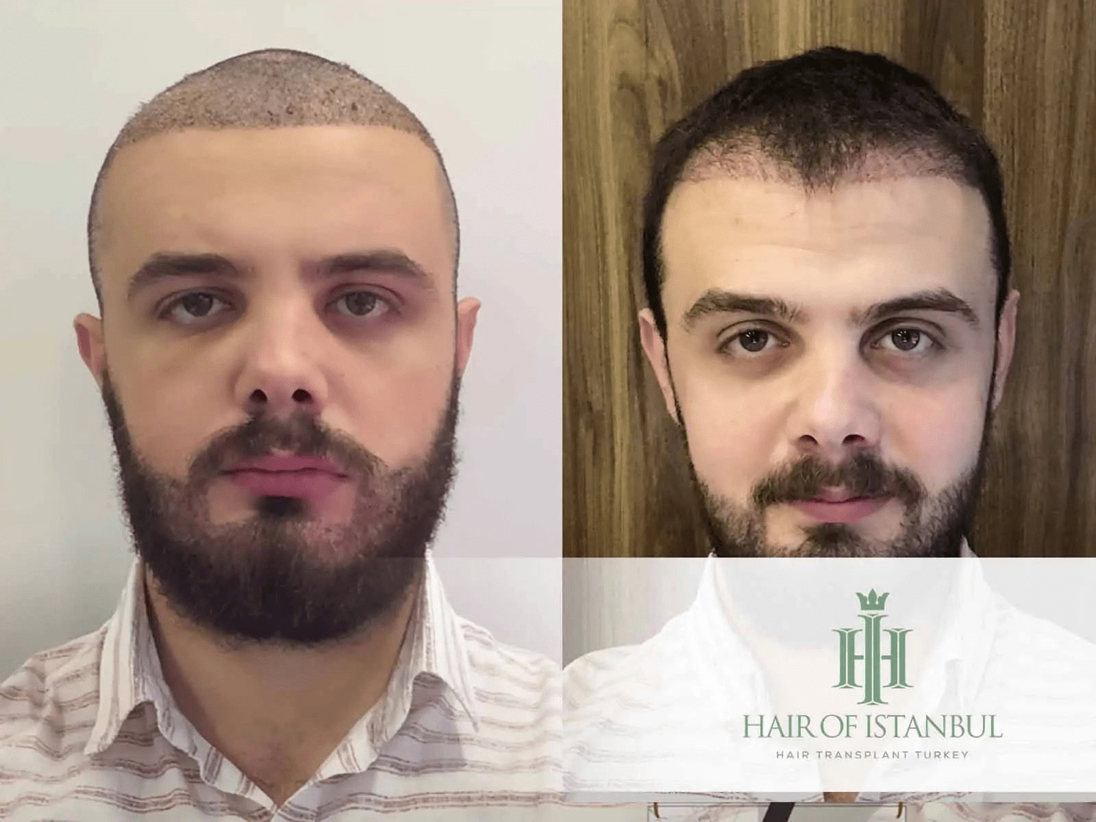 Haartransplantation nach 3 Monaten- Fotos zeigen echte Ergebnisse