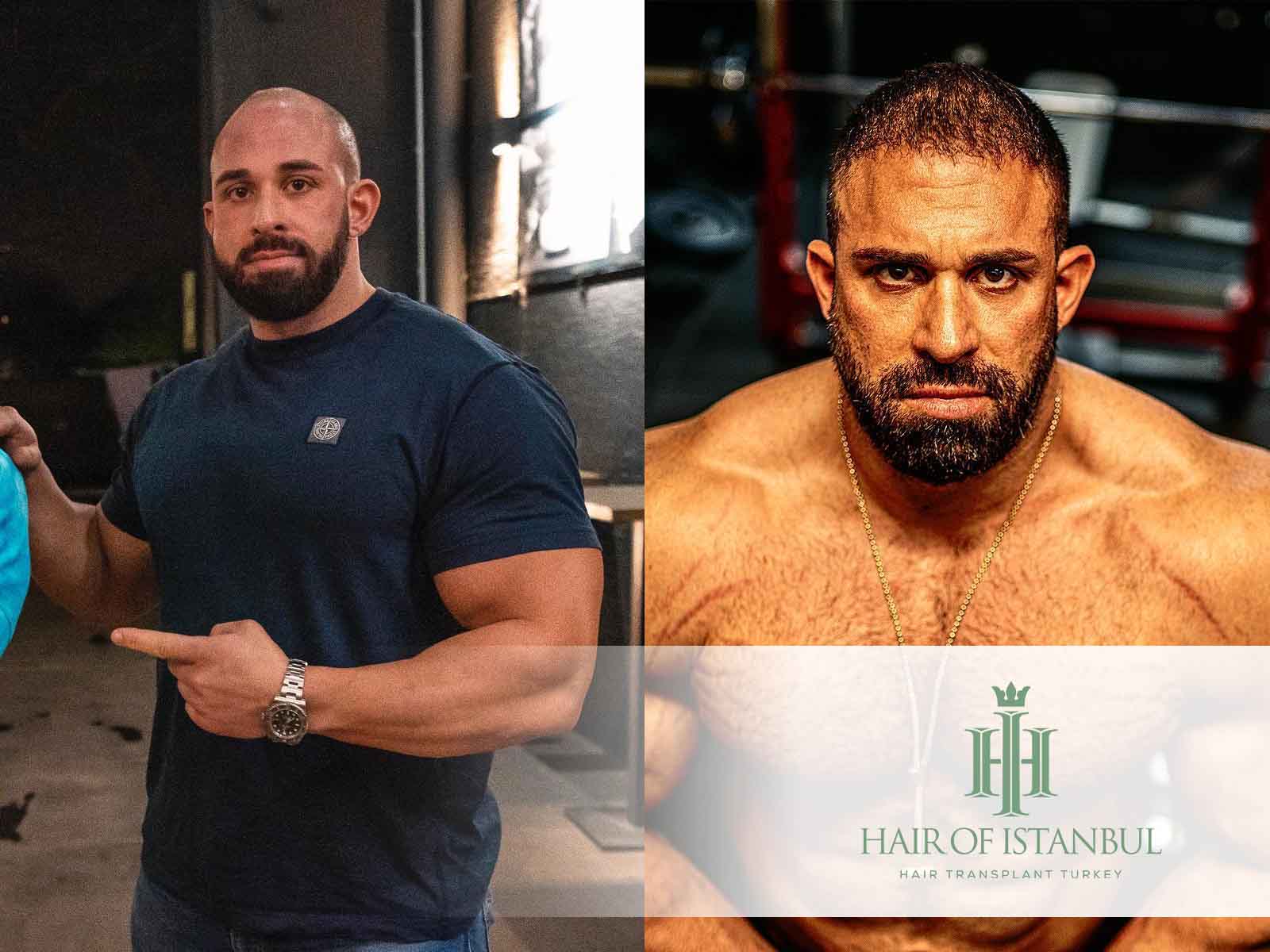 Kevin Wolter Haartransplantation: Fakten enthüllt