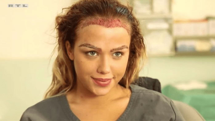 Vom Haarverlust zum Selbstvertrauen: Wie Kim Gloss ihr Haarbild Verbesserte 1 Kim Gloss vor und nach der Haartransplantation