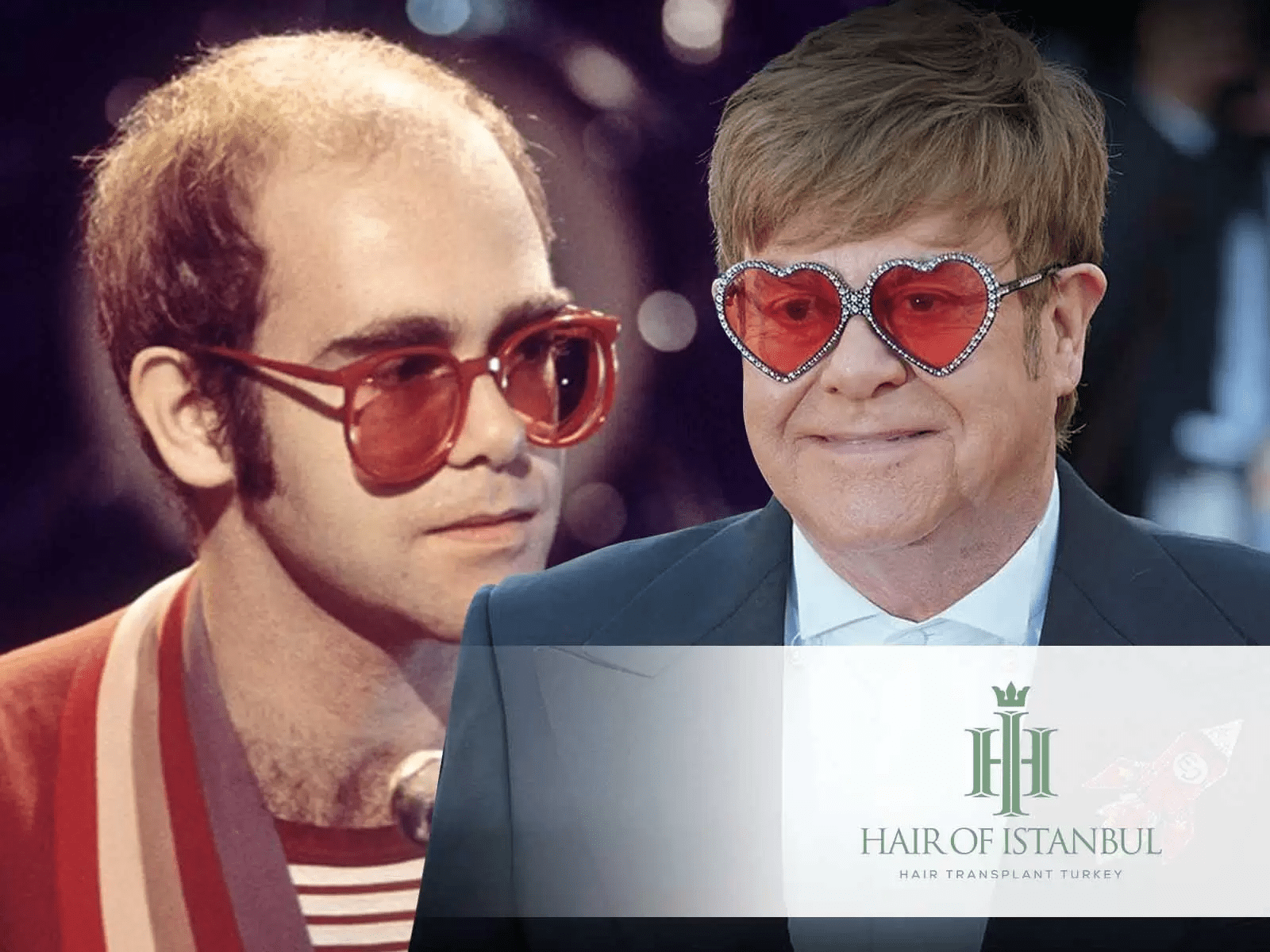 Les cheveux d’Elton John : greffe de cheveux ou toupet?