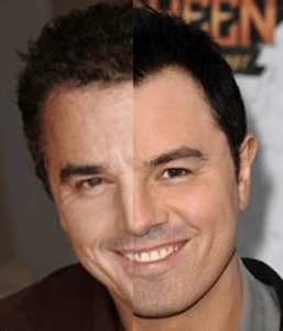 MacFarlane’s Hair Transplant
