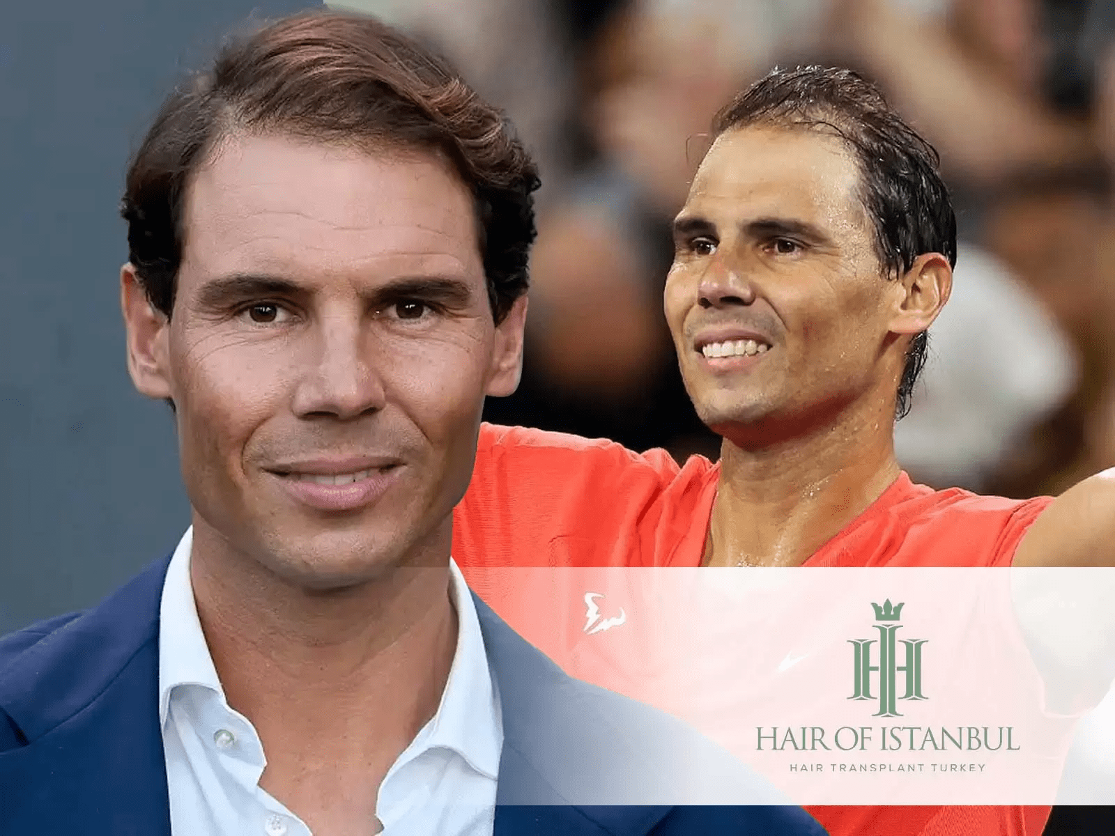 Greffe de cheveux à Rafael Nadal : Analyse de Son Look