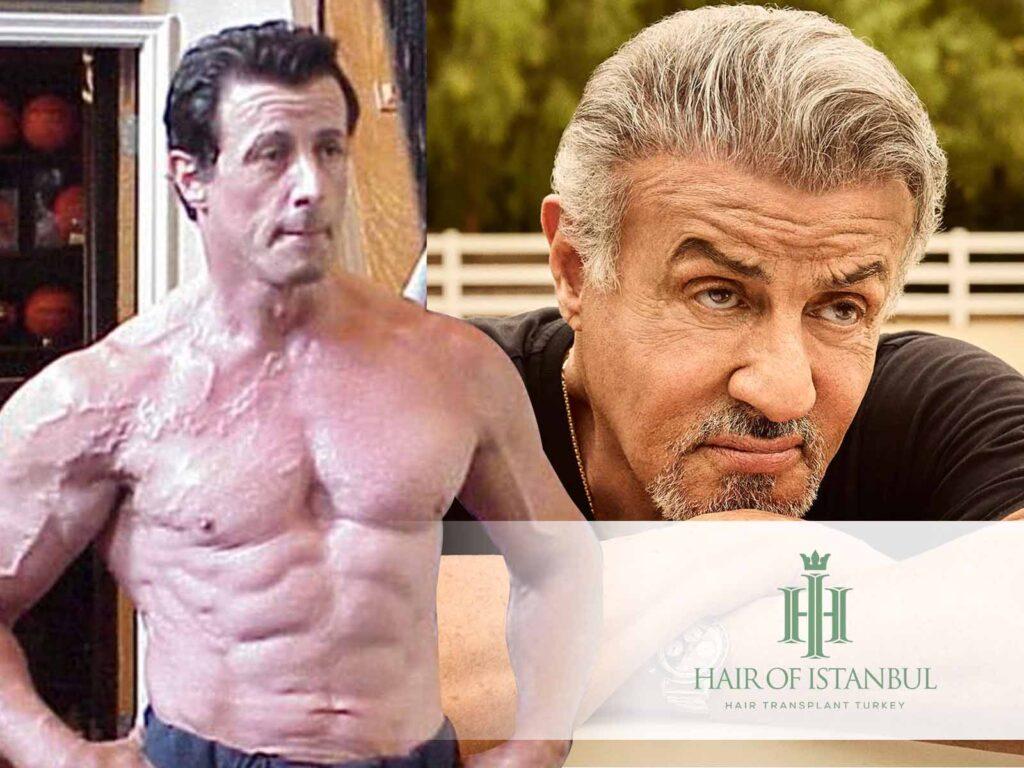 Sylvester Stallone Haartransplantation