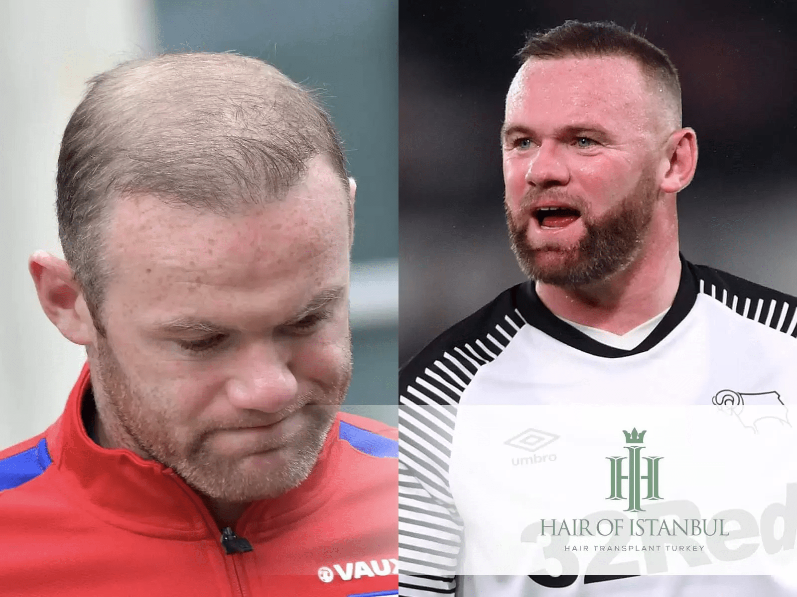 Greffe de cheveux de Wayne Rooney: Avant et Après