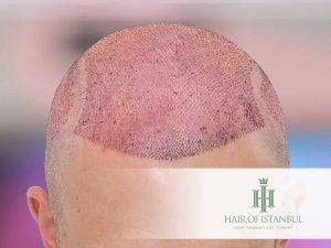 Hair Transplant Side Effects: Swelling, Redness, and Shock Loss Explained (2025 Guide) 2 redness after hair transplant