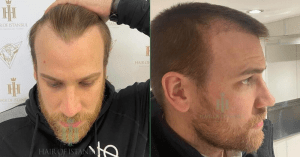 Ergebnisse der Haartransplantation im Schläfenbereich