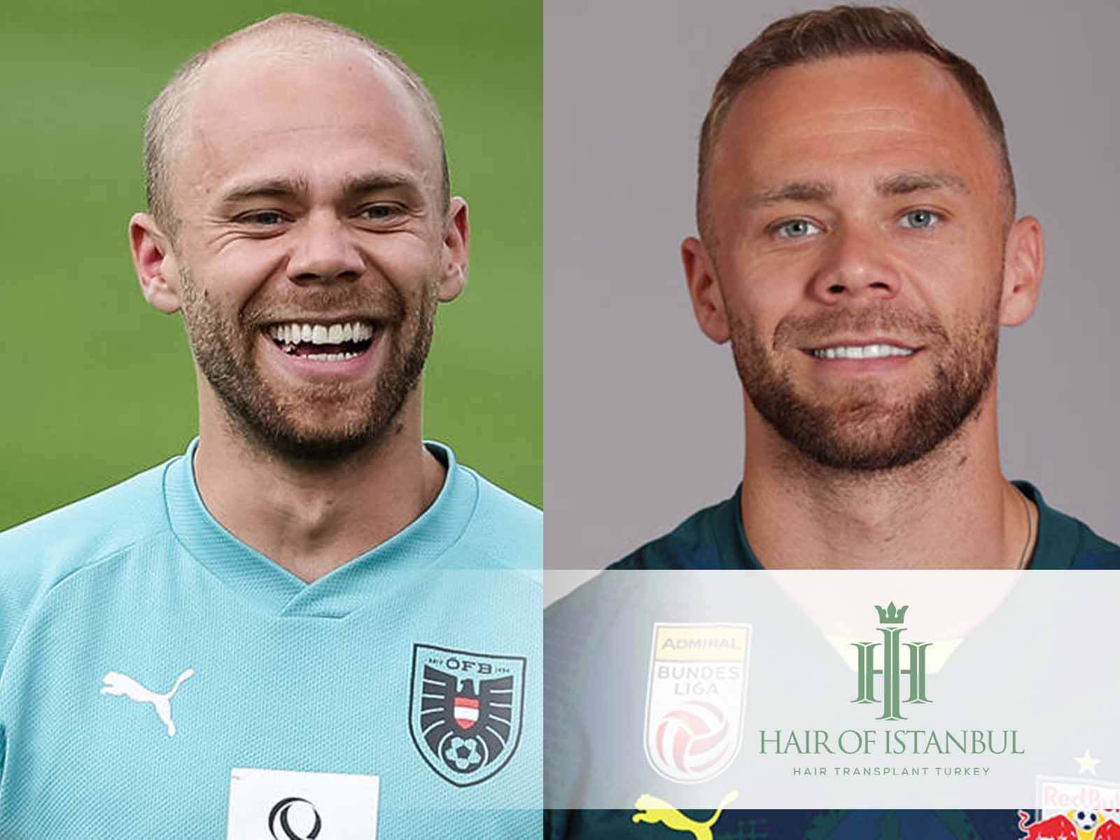 Alexander Schlager Haartransplantation: Haare, die Inspirieren