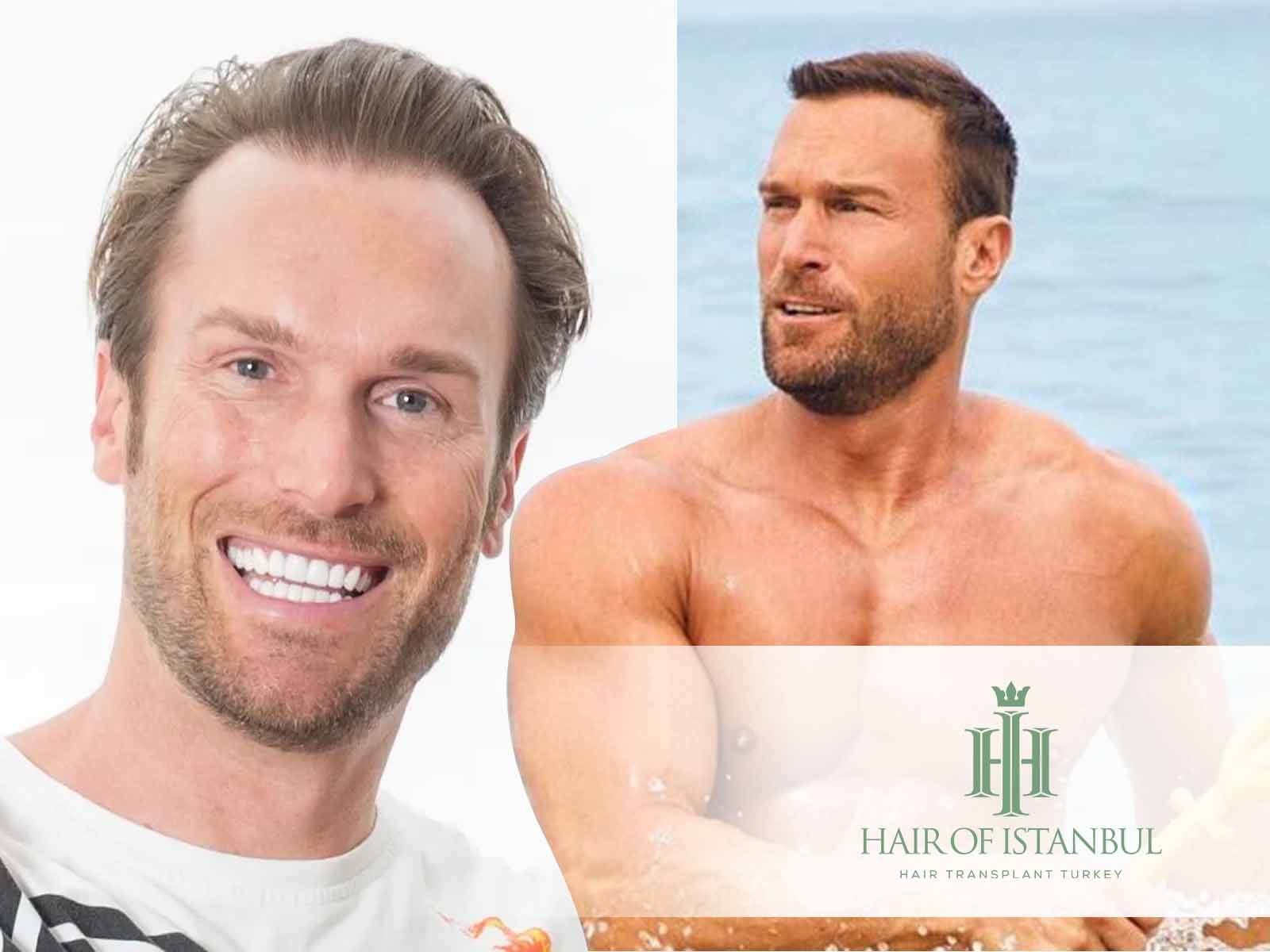 Bastian yotta haartransplantation haare wiederhergestellt