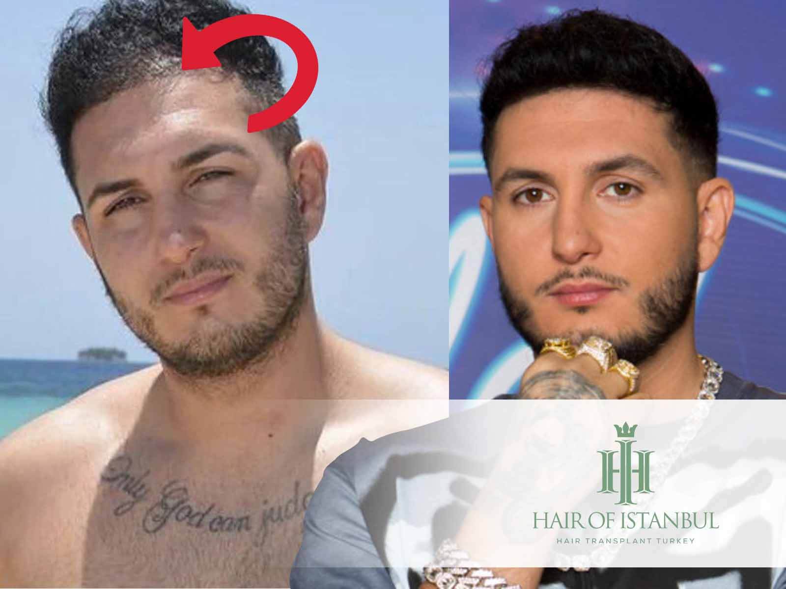 El injerto de pelo de Omar Montes: La verdad sobre su cabello