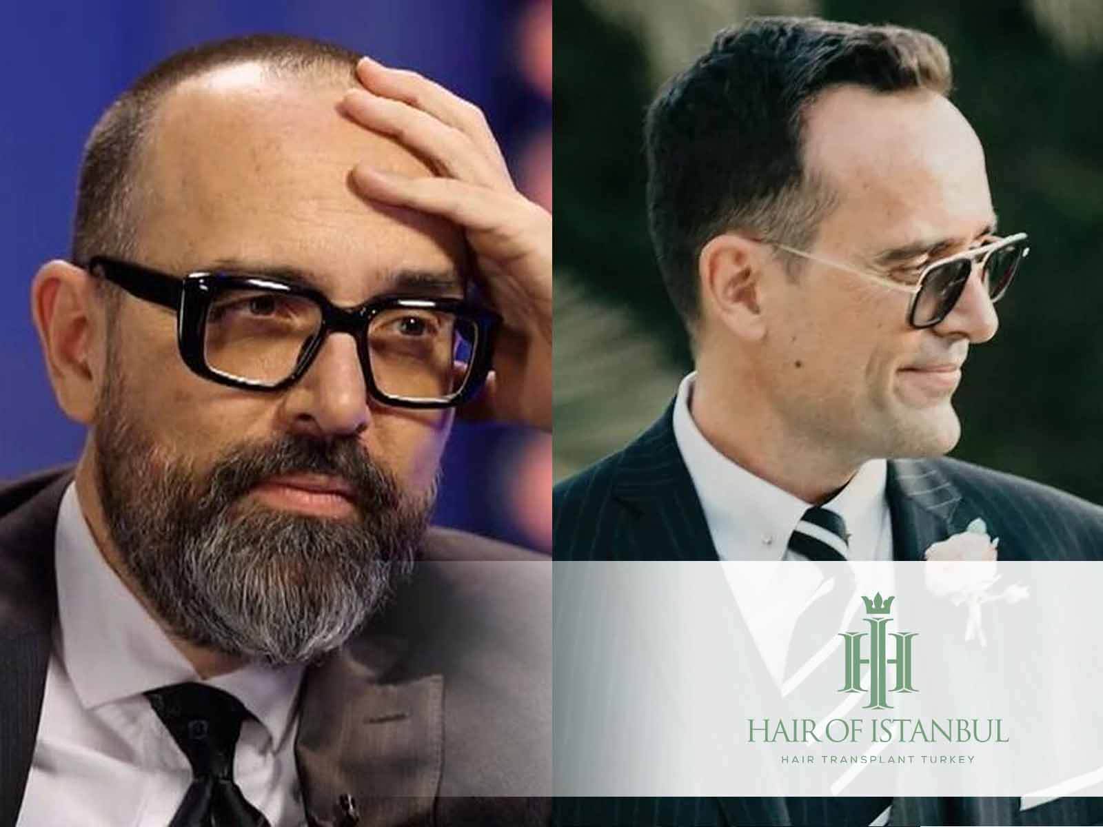 El injerto de pelo de Risto Mejide: ¿Qué sabemos realmente?