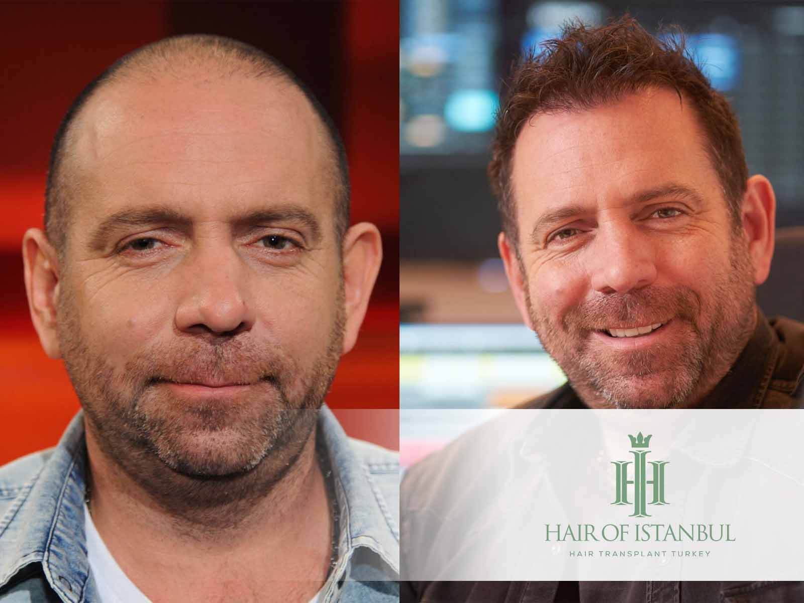 Ikke Hüftgold Haartransplantation: Gerüchte um Neue Haare