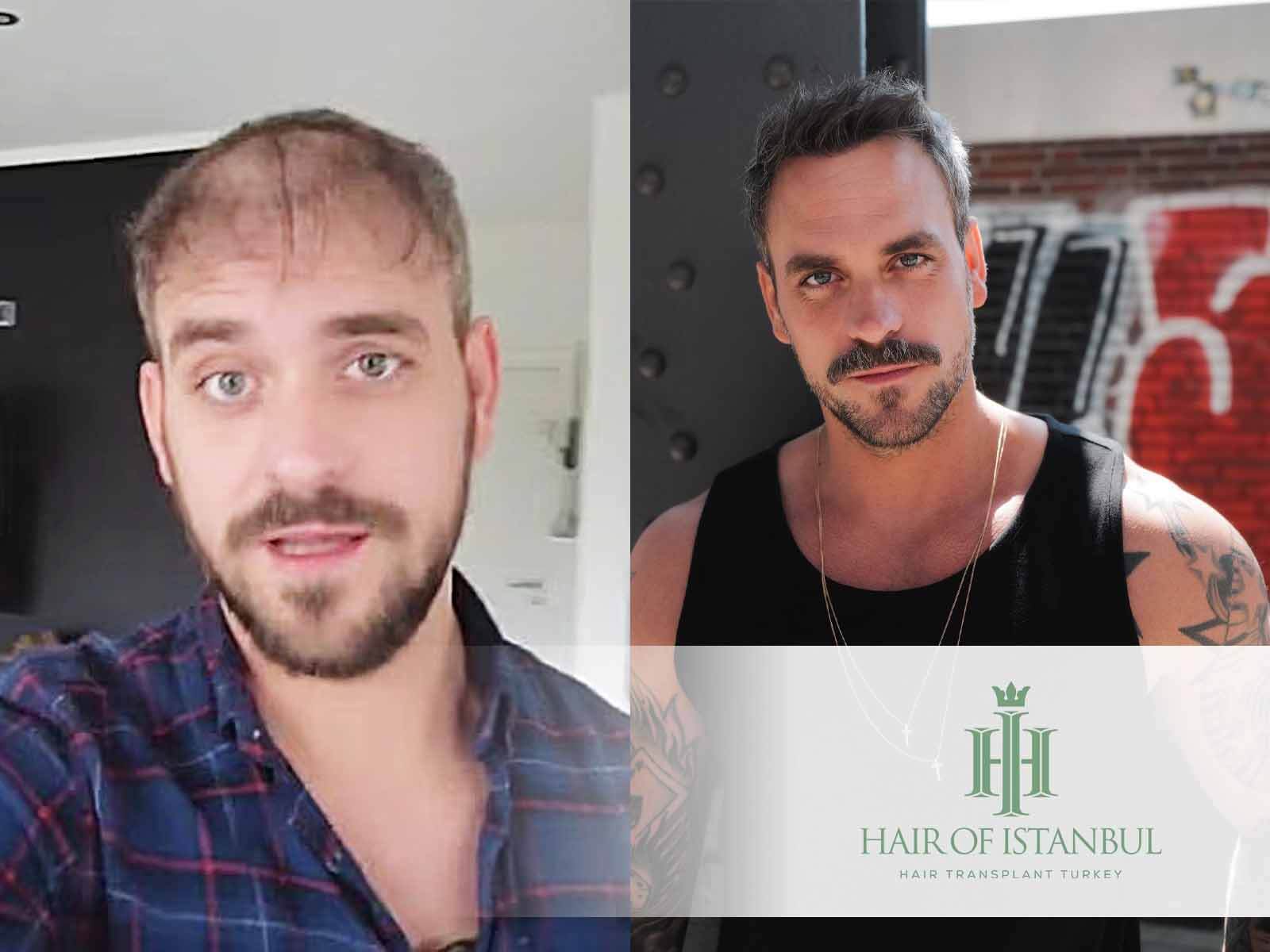 Marc Barthel Haartransplantation: Neue Haare im Rampenlicht