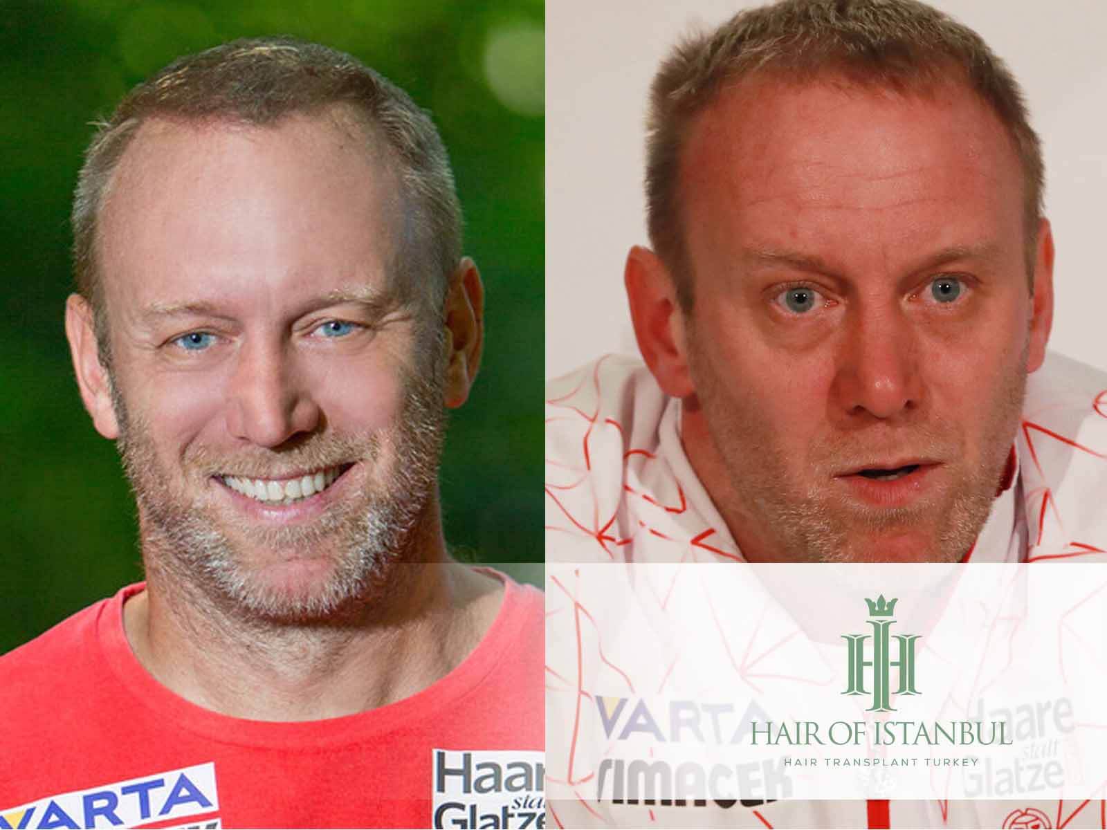 Stefan Koubek Haartransplantation: Mehr Haare, Mehr Stil