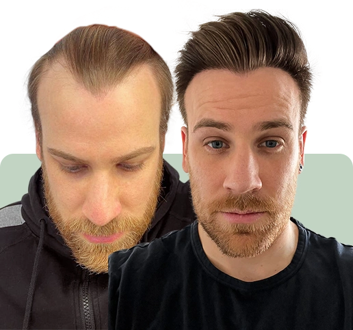 hair-transplantation-fue