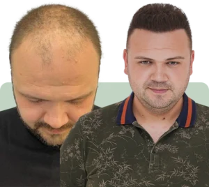 Hair Transplant After 8 Months: What Real Results Look Like in 2025 4 Before and after hair transplant result at Hair of Istanbul clinic showing natural density and restored hairline. 4