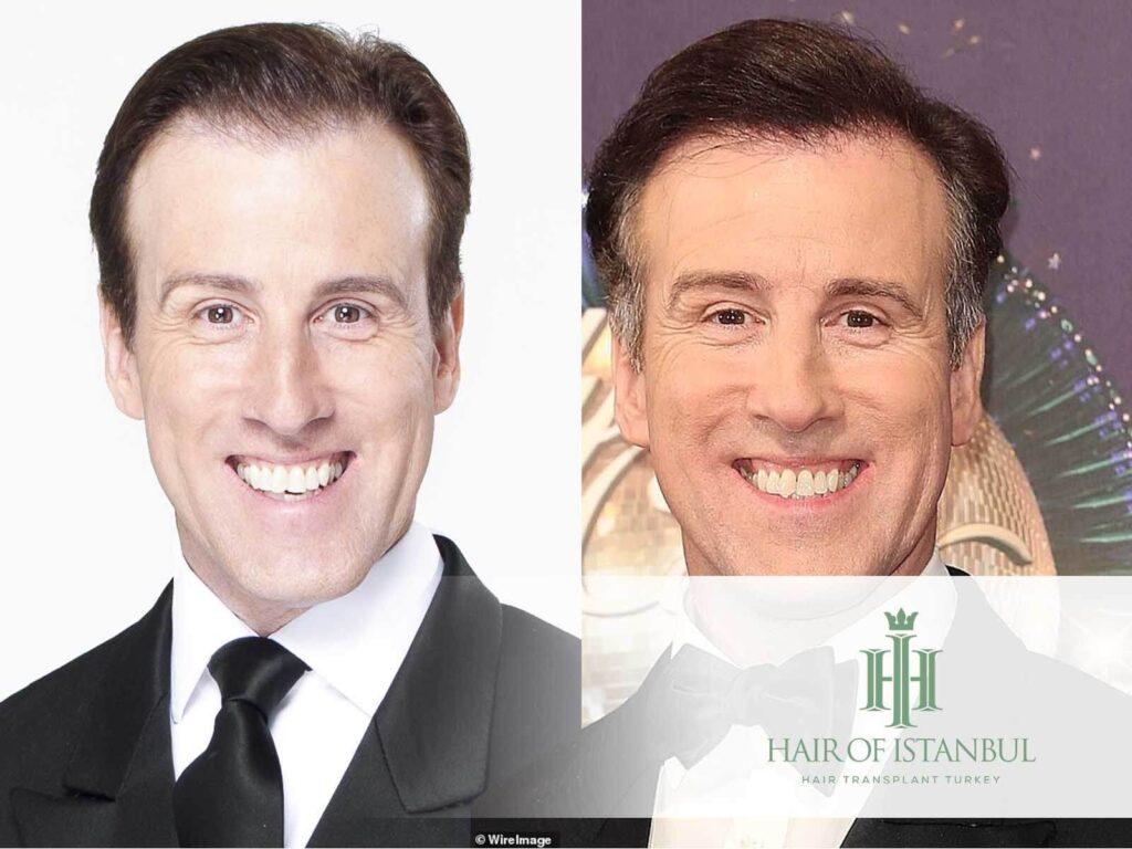 Anton Du Beke Hair Transplant