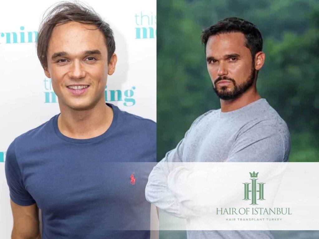 Gareth Gates Hair Transplant