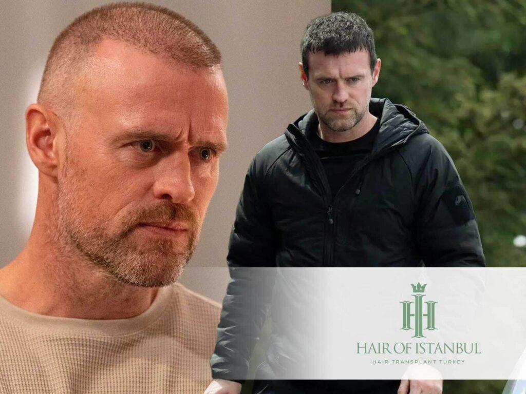 Jonas Armstrong Hair Transplant