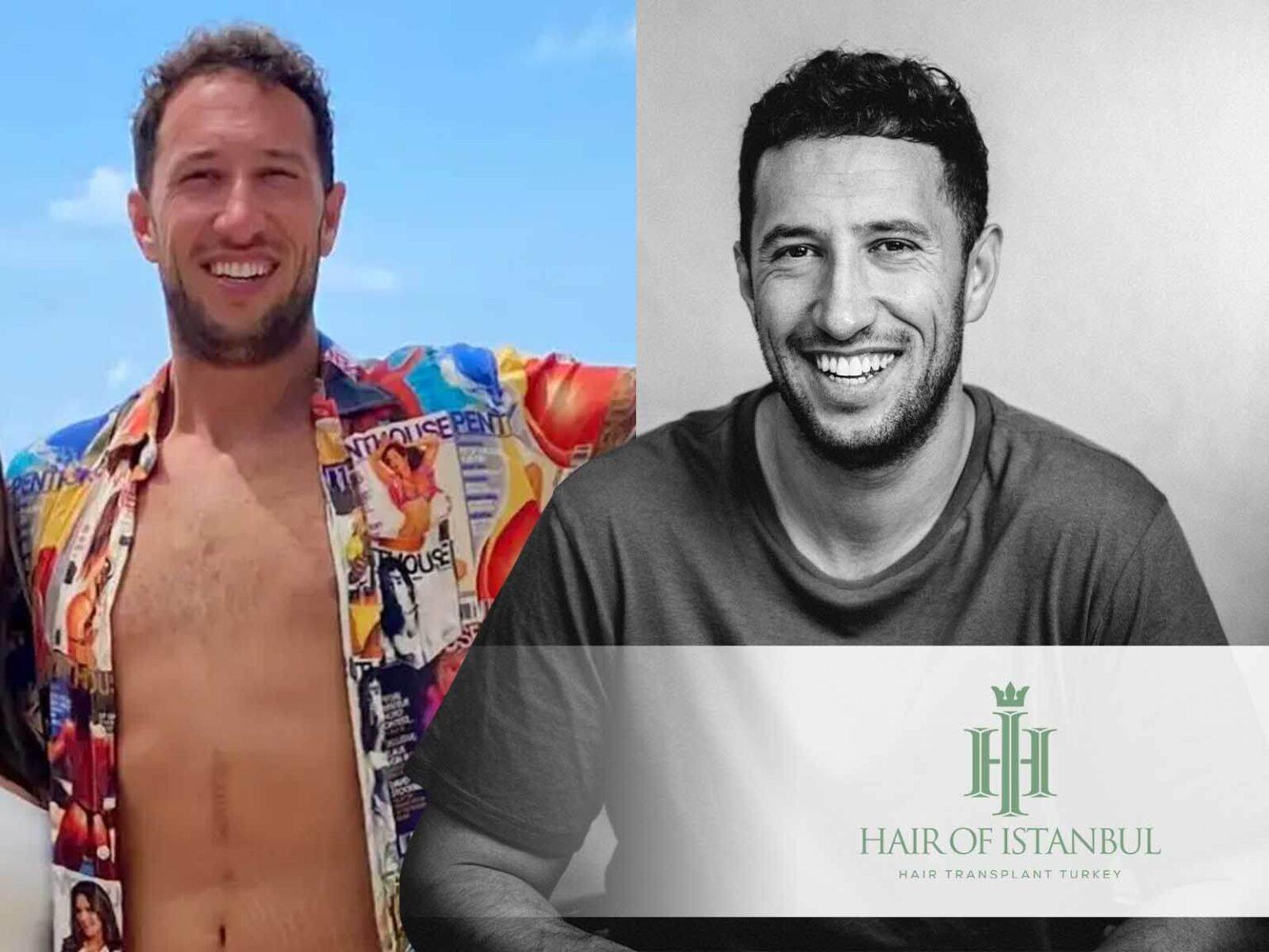 Mike Majlak Hair Transplant: Evidence of Change