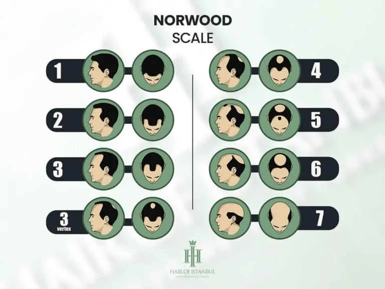 Norwood Scale Explained: Hair Loss Stages 1–7
