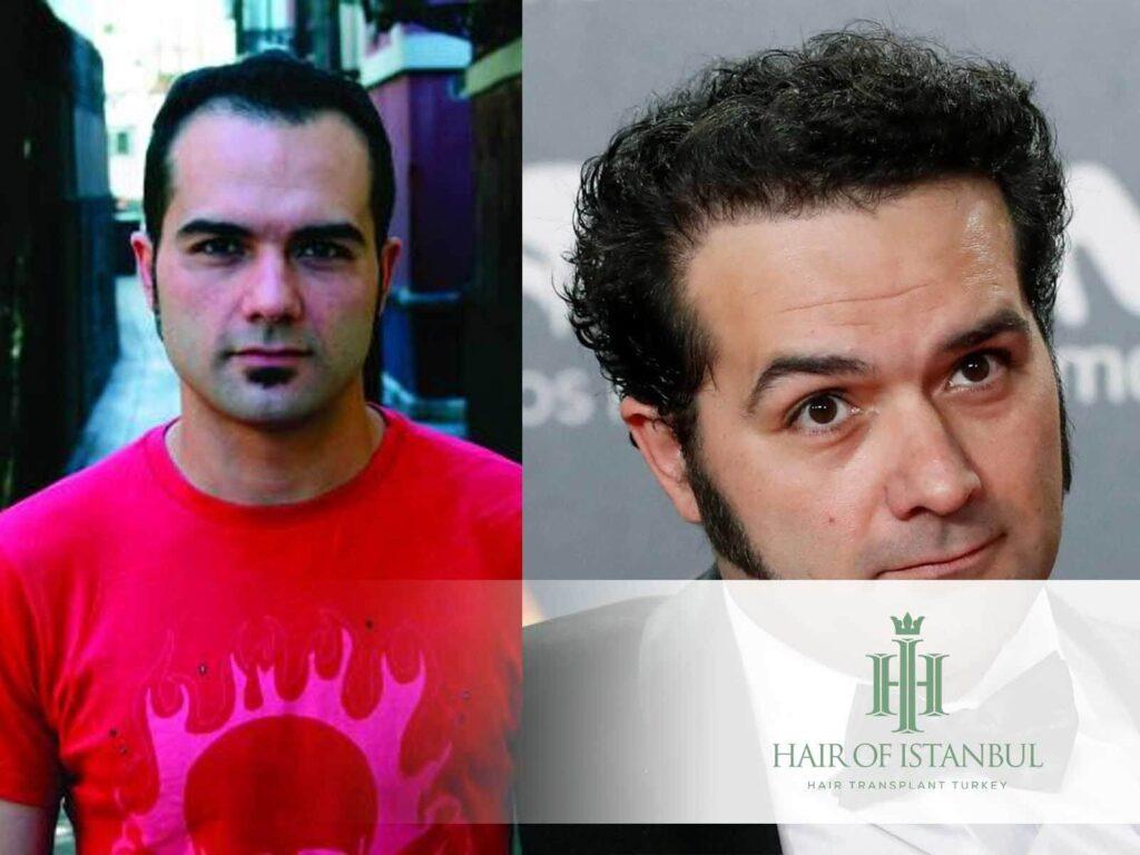 El injerto de pelo de Alfonso Sánchez