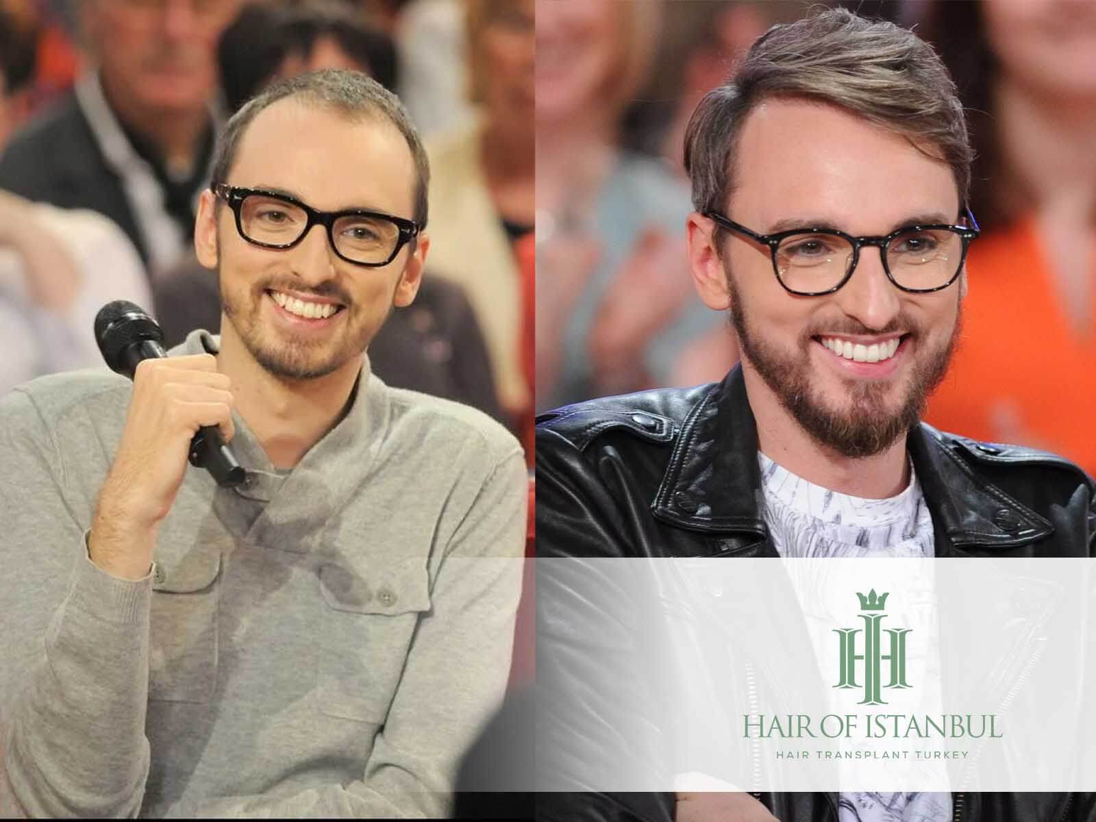 Greffe de cheveux de Christophe Willem : Détails et vérités
