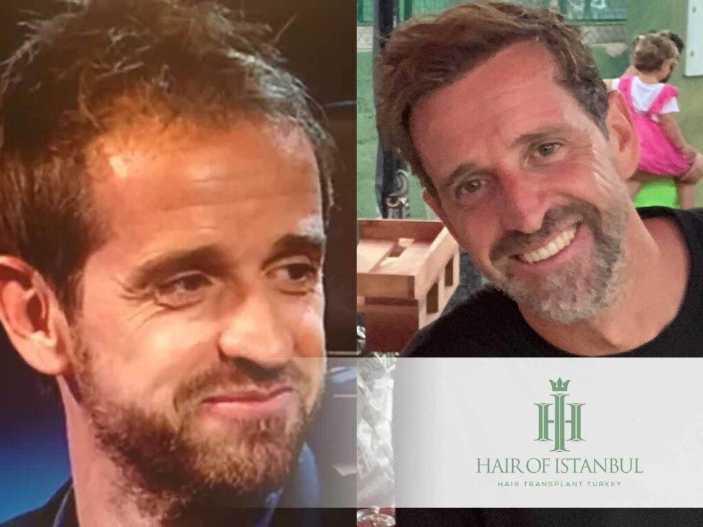El injerto de pelo de Gerard Autet