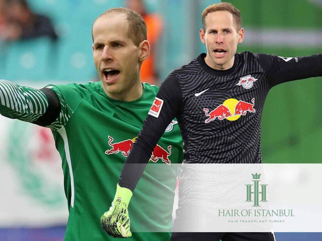 Peter Gulacsi Haartransplantation