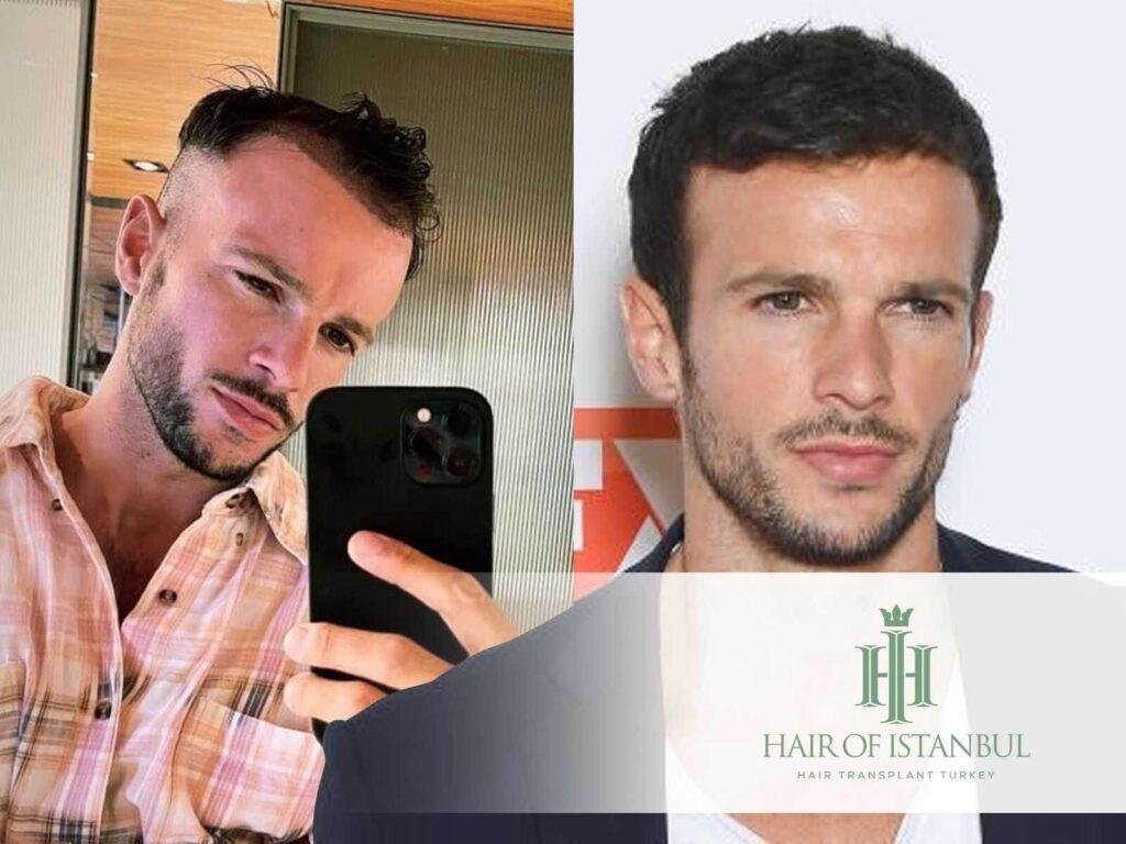 Greffe de cheveux de Hugo Philip