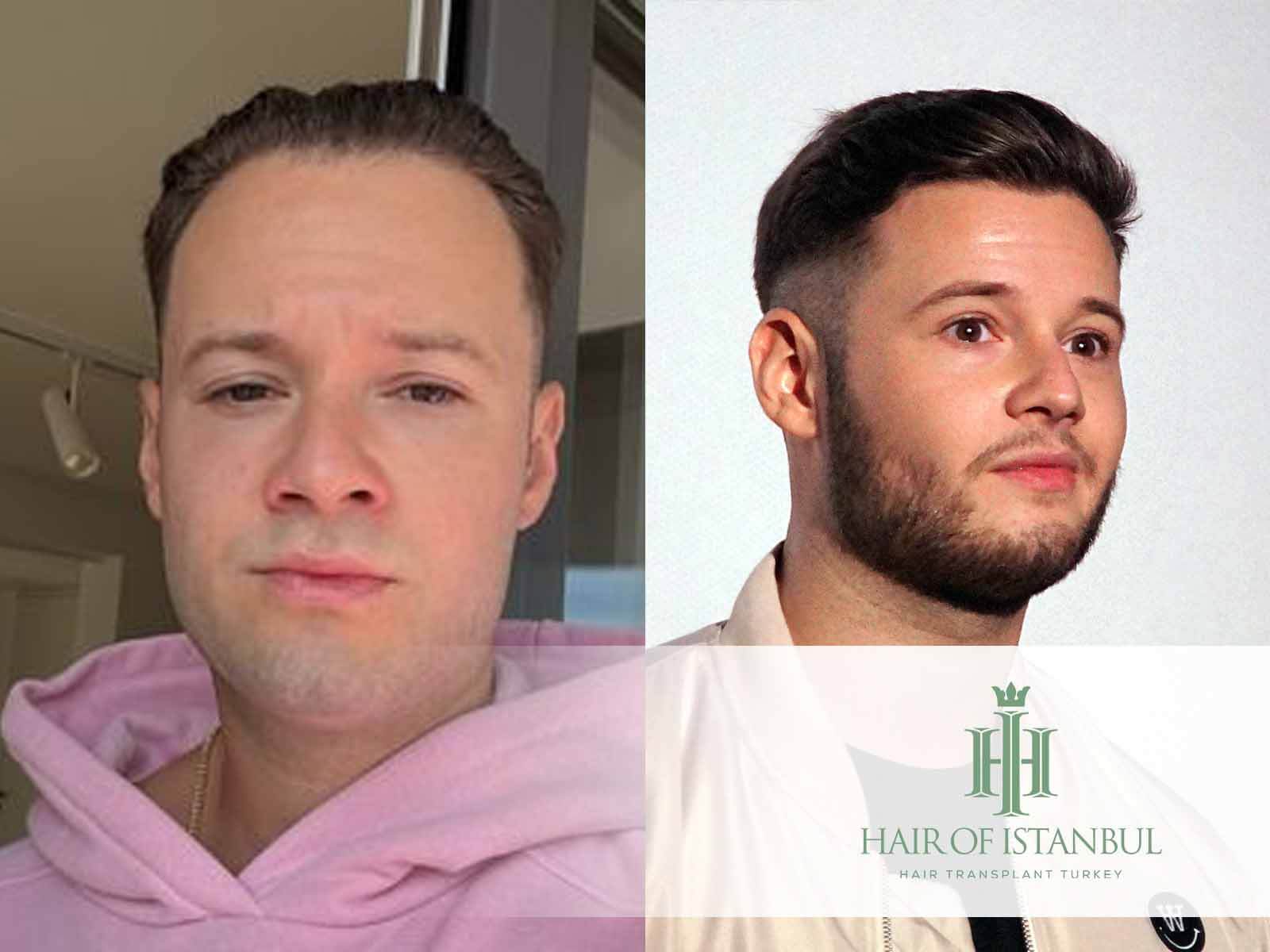 Inscope Haartransplantation: Alles über den Eingriff