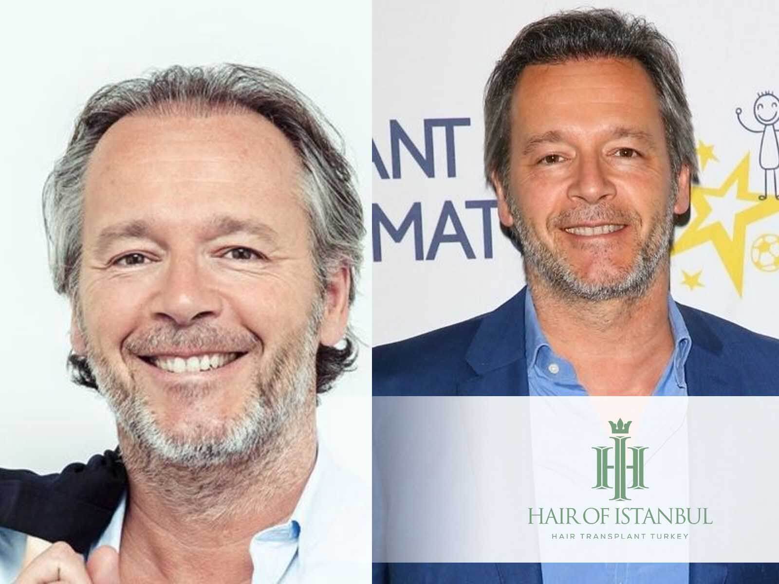 Greffe de cheveux de Jean Michel Maire : Avant et après