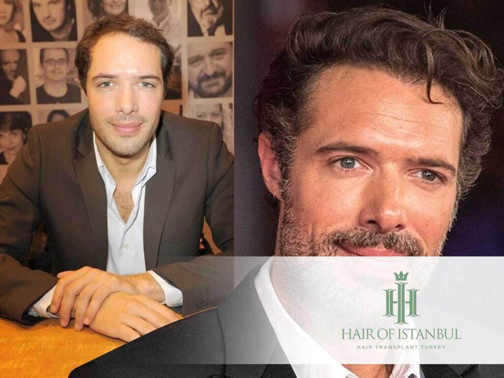 Greffe de cheveux de Nicolas Bedos