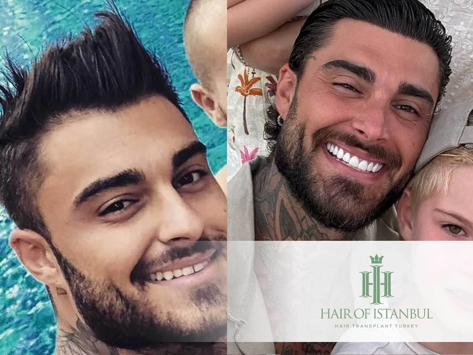 Greffe de cheveux de Thibault Garcia : Tout sur la procédure