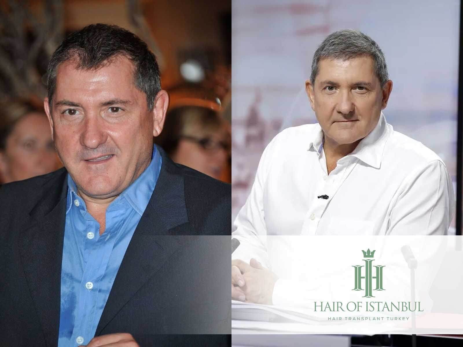 Greffe de cheveux de Yves Calvi : Rumeurs ou réalité?