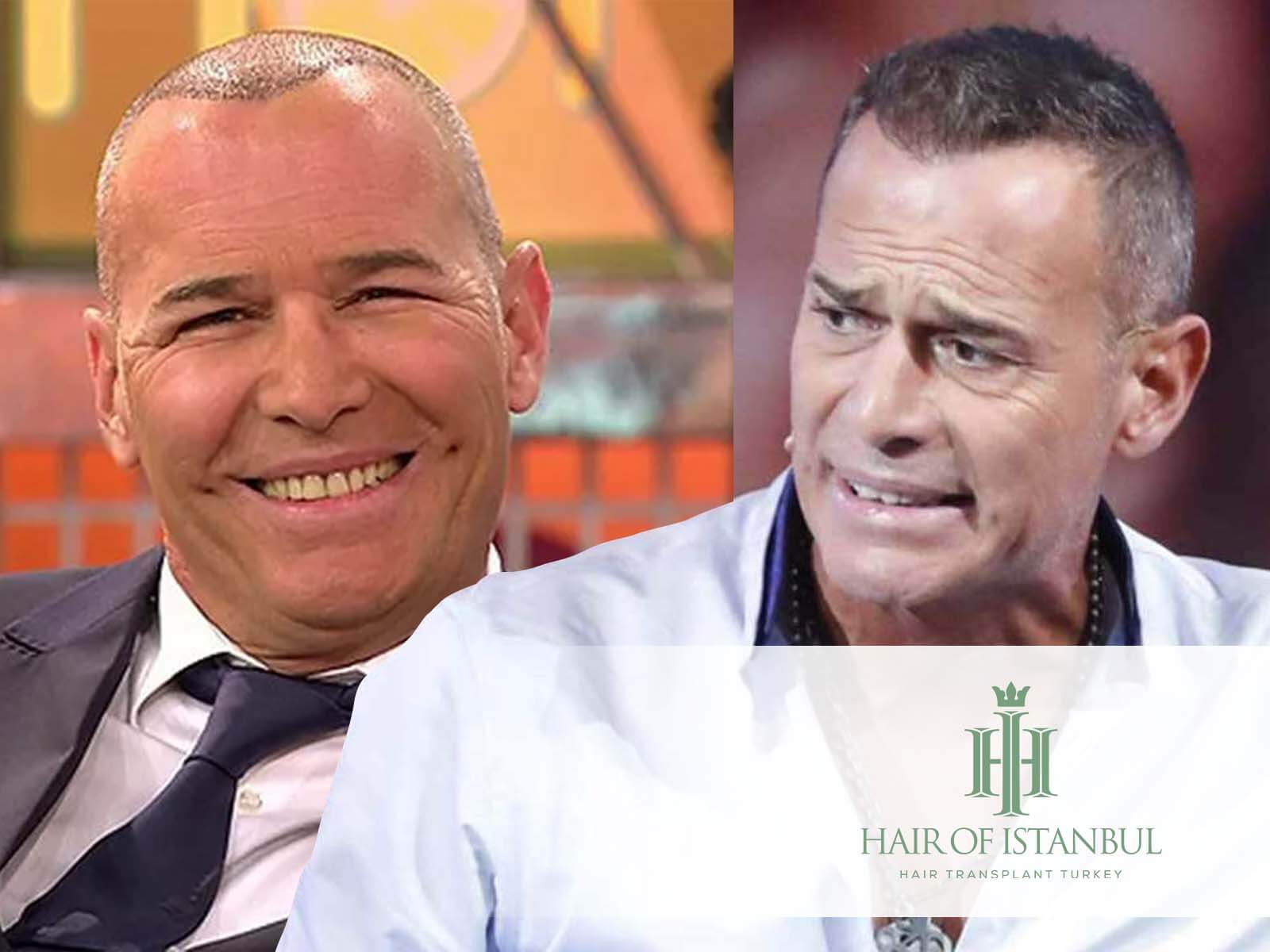El injerto de pelo de Carlos Lozano: Estilo natural y renovado