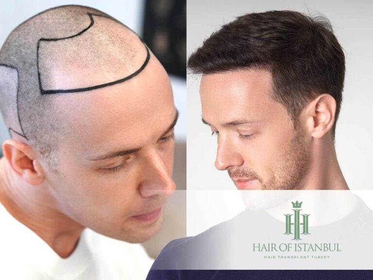 What a Dislodged Hair Graft Looks Like — and What It Does Not