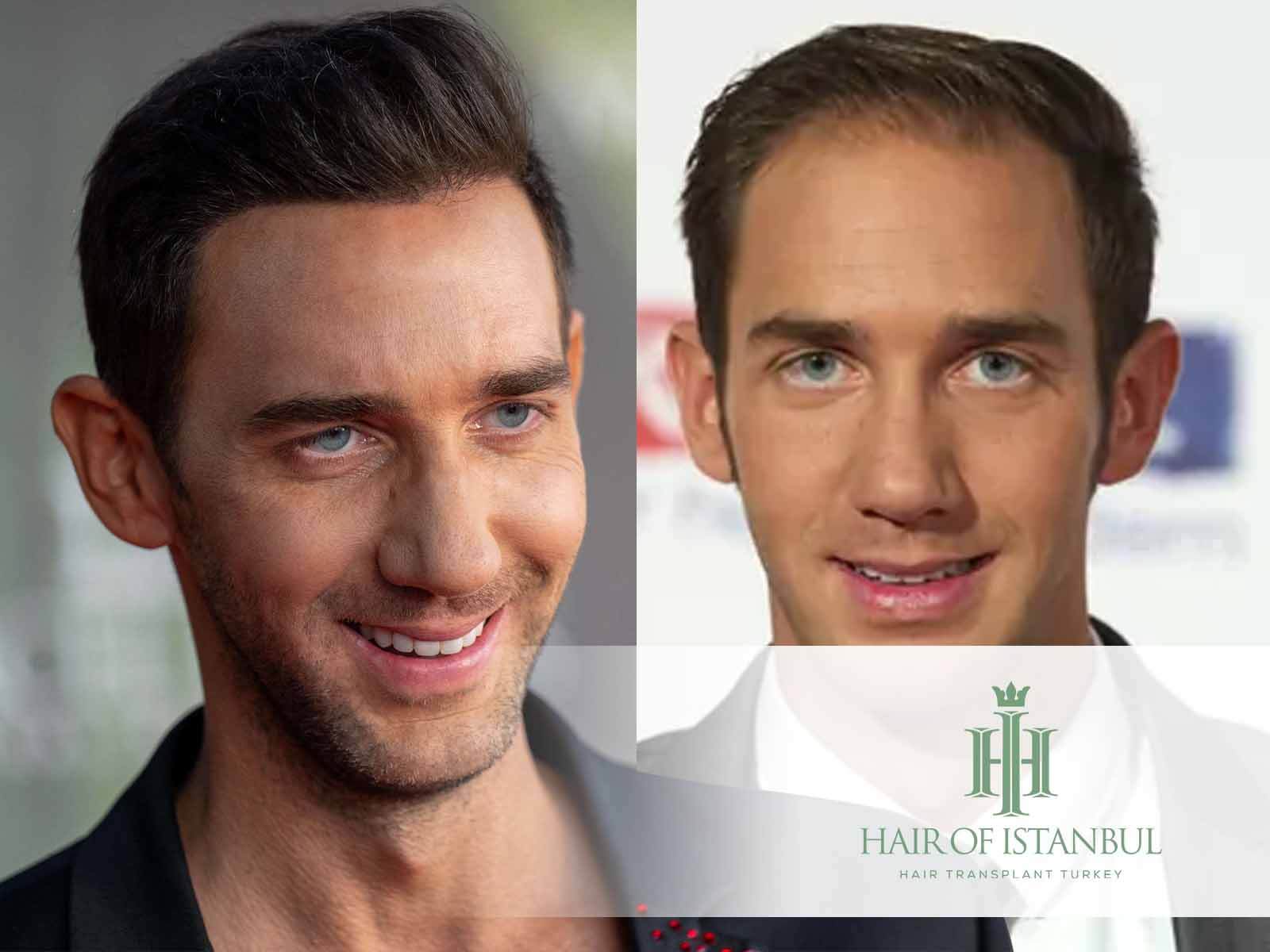 Marcel Remus Haartransplantation: Haare zurück, Glatze weg