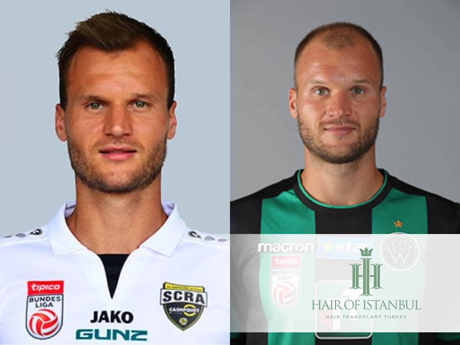 Matthias Maak Haartransplantation: Neue Haare, neuer Look?