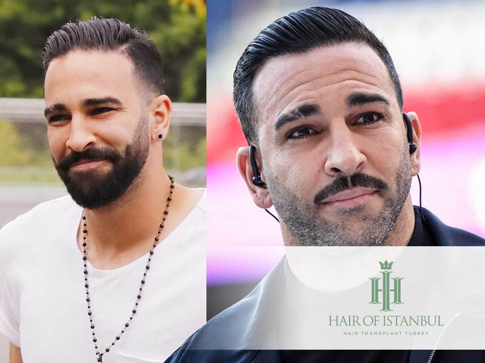 Greffe de cheveux de Adil Rami