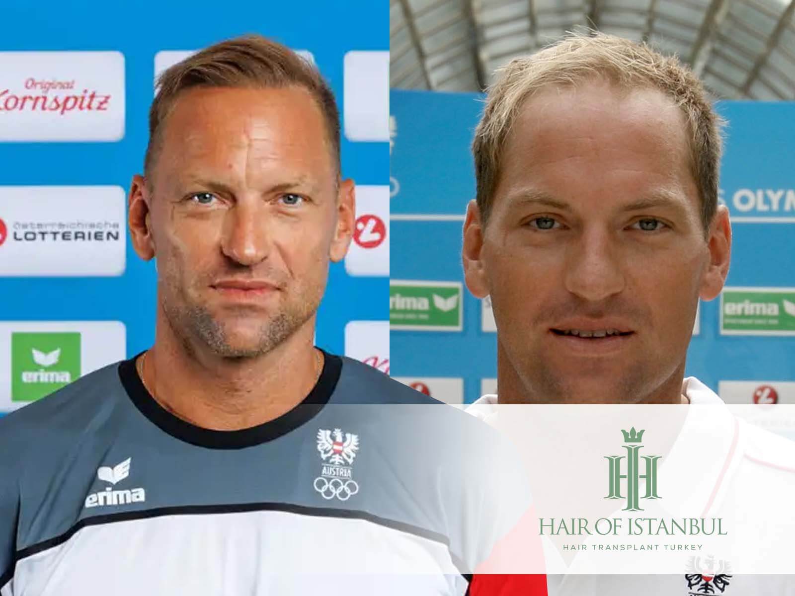 Alexander Horst Haartransplantation: Haare voll, aber natürlich