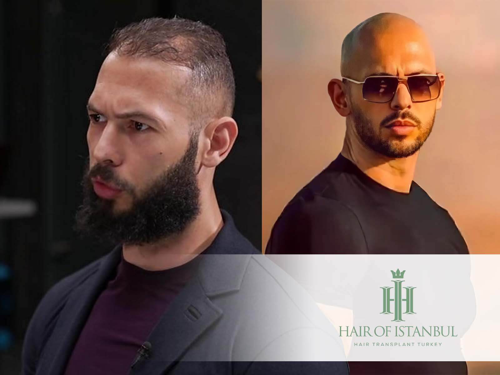 Hair Restoration Dr John Diep Hair Transplant Natural Hair