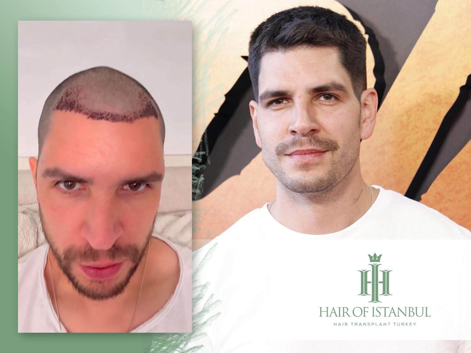El injerto de pelo de Diego Matamoros
