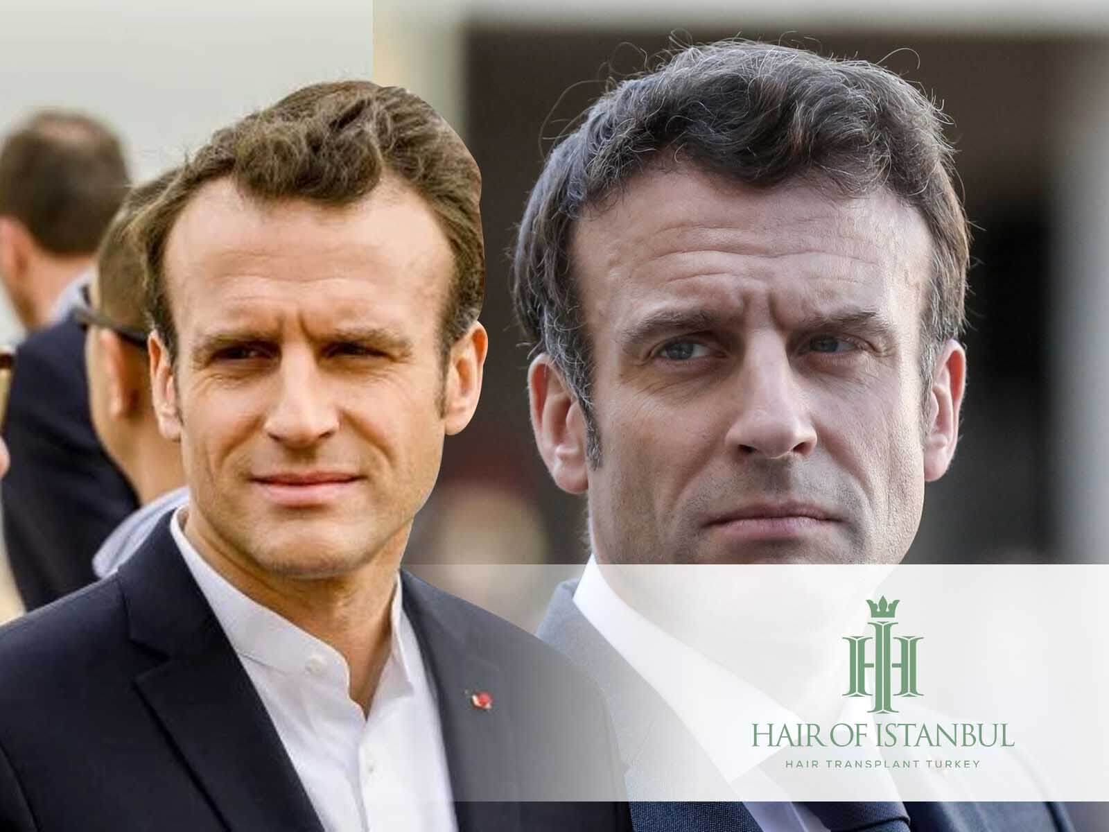 Greffe de cheveux de Emmanuel Macron