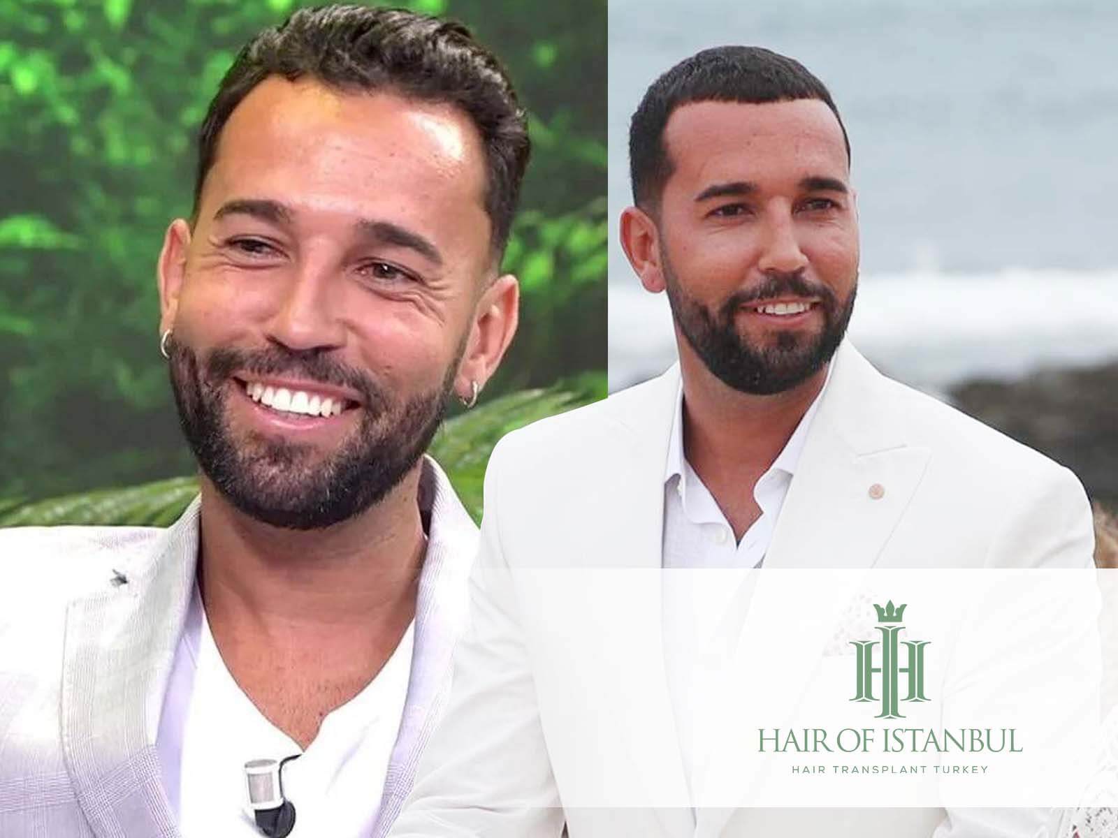El injerto de pelo de Omar Sánchez