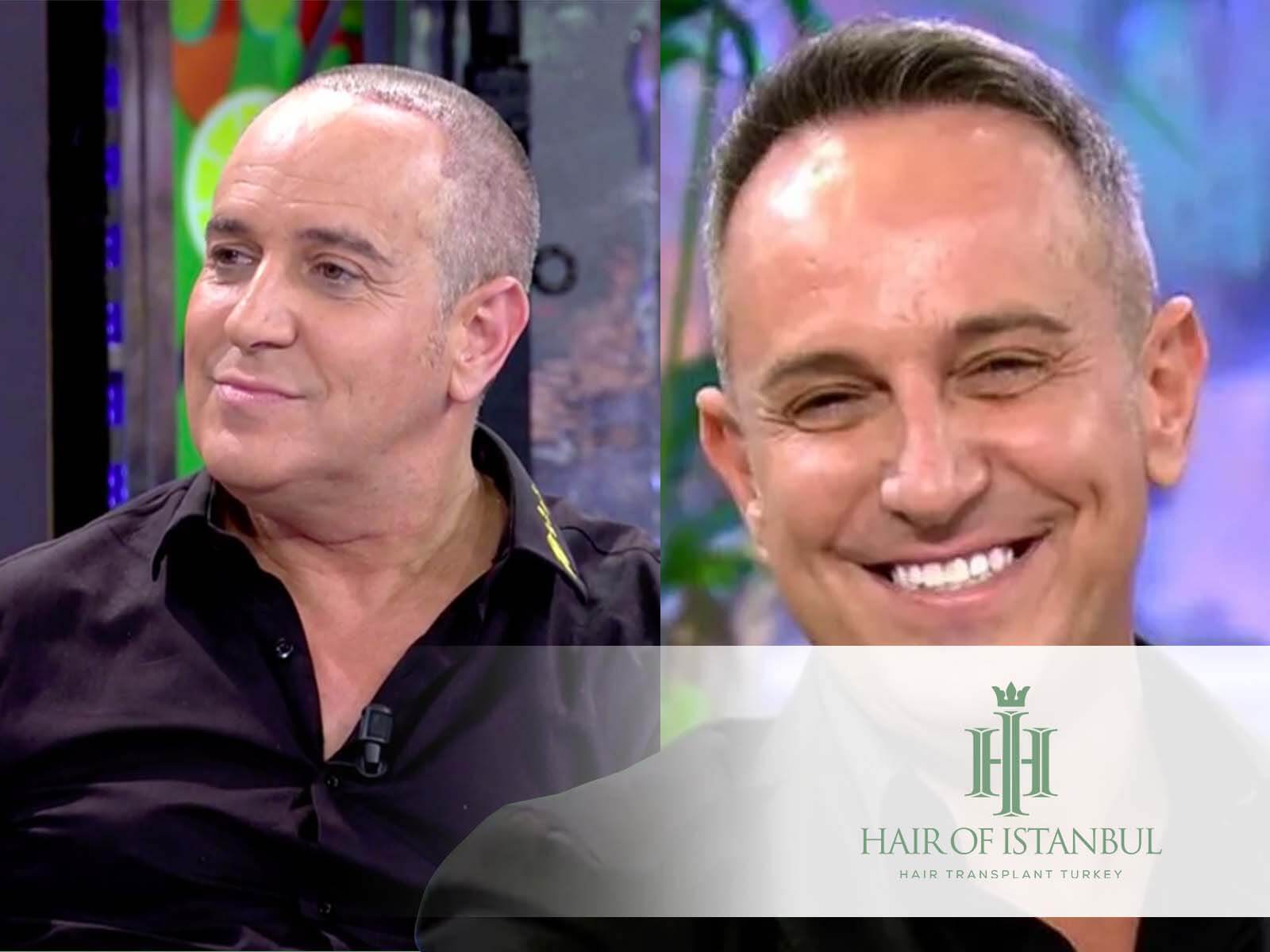 El injerto de pelo de Victor Sandoval