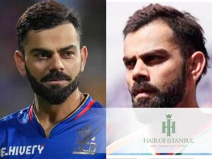 Virat Kohli Hair Transplant: Expert Analysis Before & After