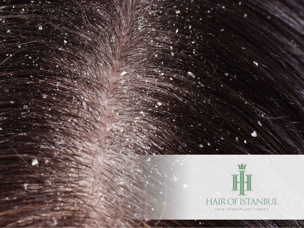 Dry Scalp and Scabs After a Hair Transplant: What Is Normal