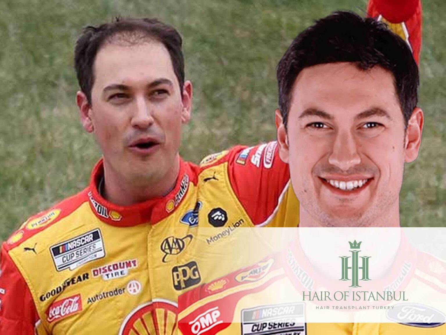 Joey Logano Hair Transplant Before and After His Procedure